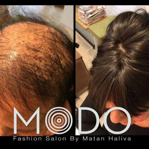 מילוי שיער דליל מאוד לפני ואחרי